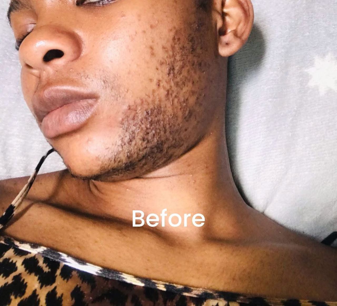 Camila ICE laser device in room